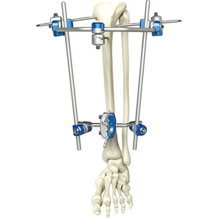 Orthopedic proximal tibia  external fixator