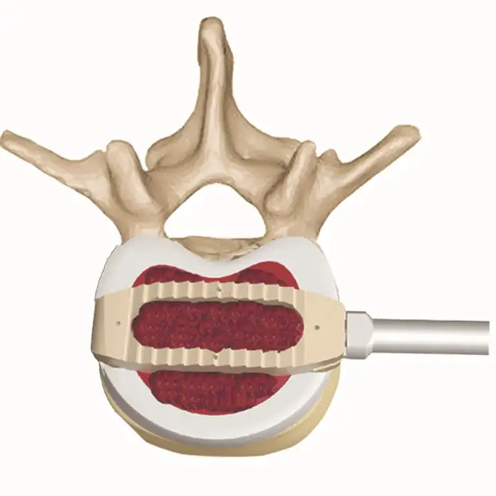 Spine Lateral Lumbar Cage for OLIF DLIF Cage