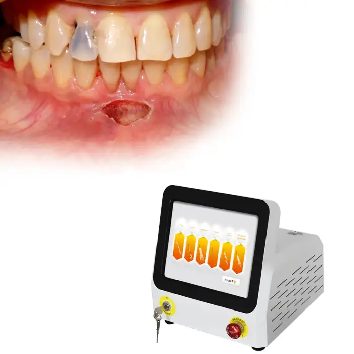 Diode Oral Soft Tissue Surgery 980nm dental laser Medical Dental Laser Machine For Gingivectomy