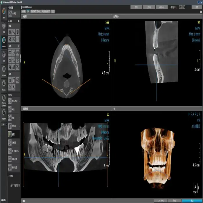 Used HDX-DENTRI-S panoramic dental x ray machine  3d CBCT