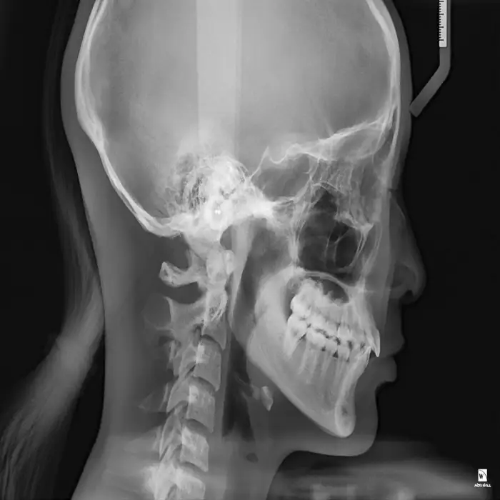 Used HDX-DENTRI-S panoramic dental x ray machine  3d CBCT