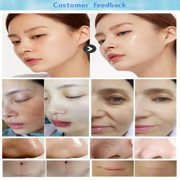 Golden supplier dermabrasion facial skin care machine