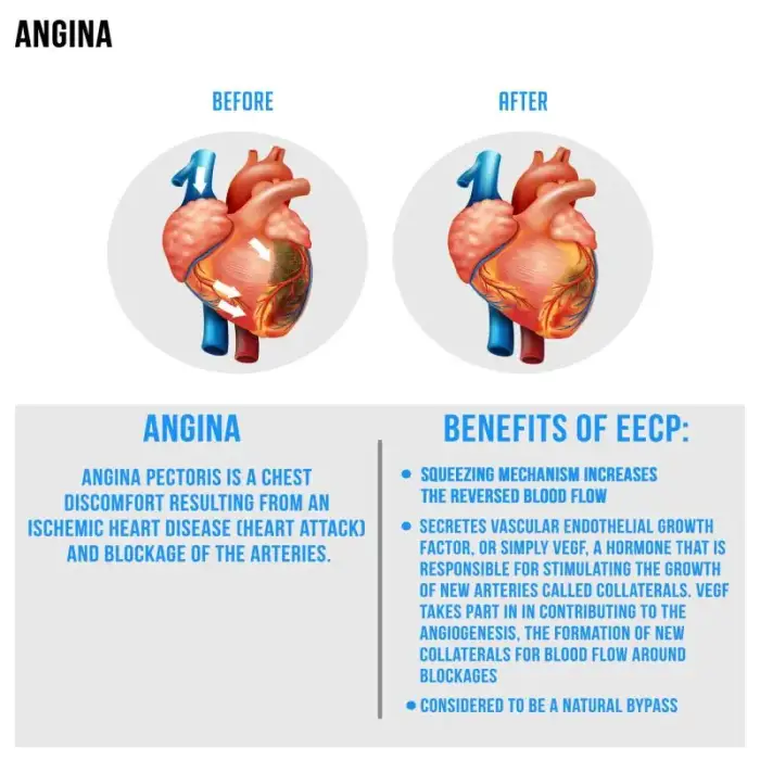 Best Effective ECP machine EECP medical device for Angina Treatment without open heart surgery