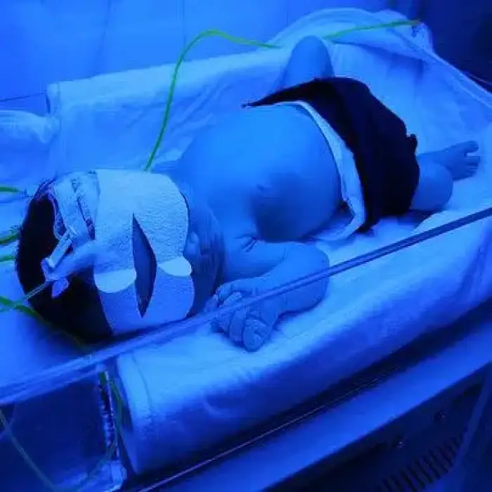 NBB2 Neonate Bilirubin Phototherapy Equipment Neonatal Jaundice Treatment Fluorescent lamp as light source