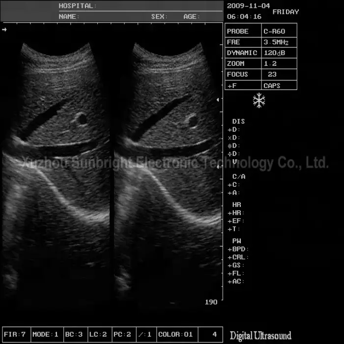 medical use sonography machine portable ultrasound sonar