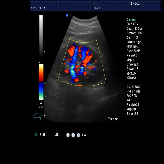 Professional vascular doppler ultrasound machine