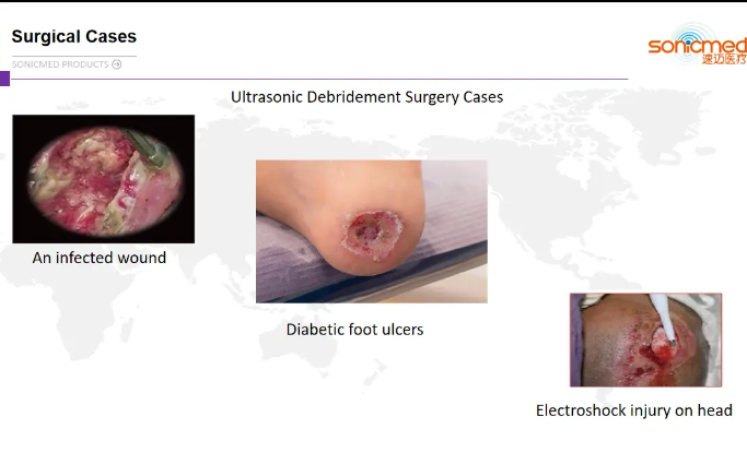 Trauma Surgery Wound Debridement Devices Ultrasonic Surgical System