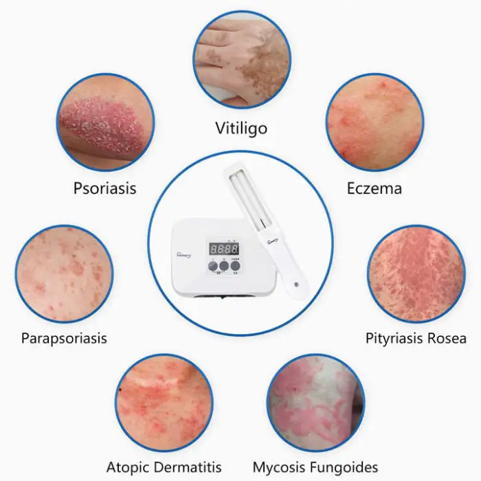 Vitiligo Machine 311nm UVB Phototherapy Equipment for Psoriasis Treatment