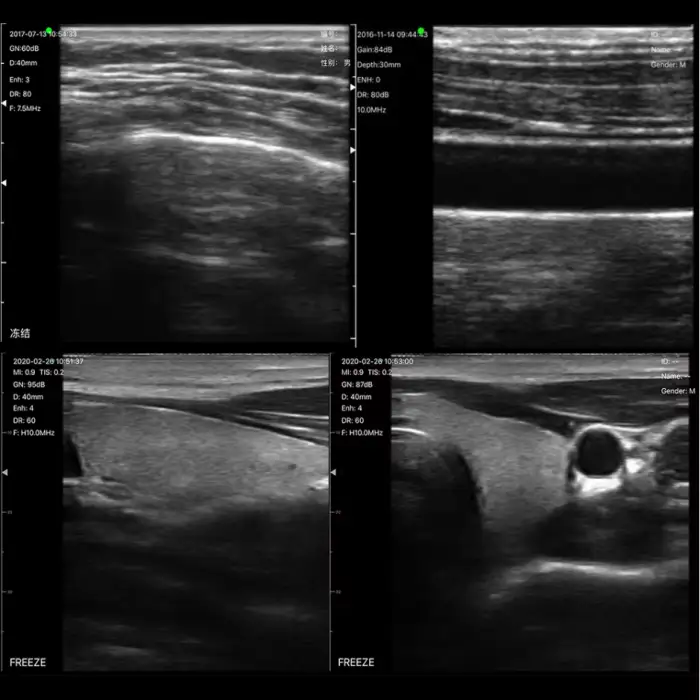 Clinic Use B/W 128 Elements Linear Probe Wireless Ultrasound Scanner Machine Available Skin Detector