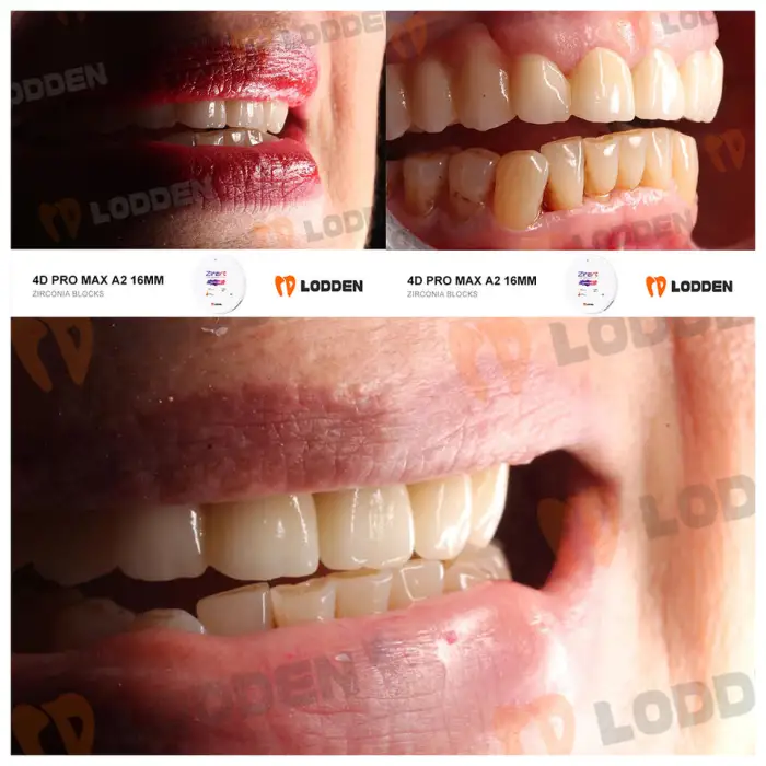 4DPRO MAX Zirconia Block Multilayer for CAD Cam Dental Milling Machine 98mm Zirconia Discs Dental Lab Zirconia Blanks