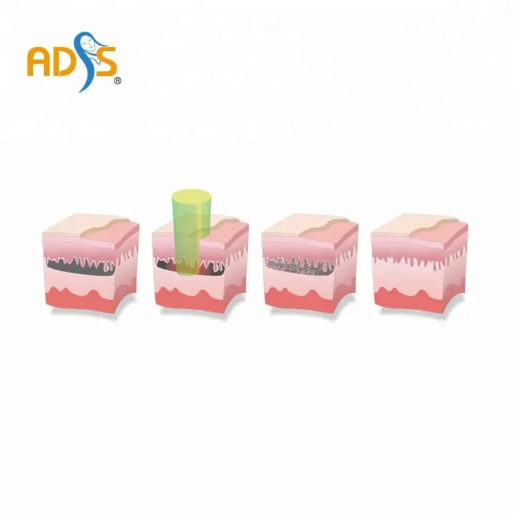 ADSS Q-switch Laser Tattoo Removal and Skin Rejuvenation with Carbon Laser Peeling — image 2
