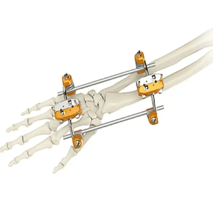 Hoffman design ulna&amp;radius spanning external fixator orthopedic device